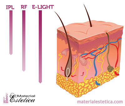 Reduce el acné con Luz Pulsada intensa (IPL)