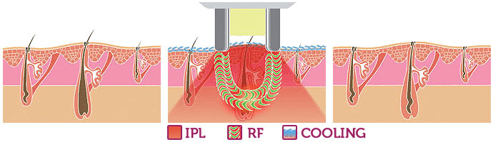 Luz pulsada intensa (IPL) vs depilación láser – Larouge skincare