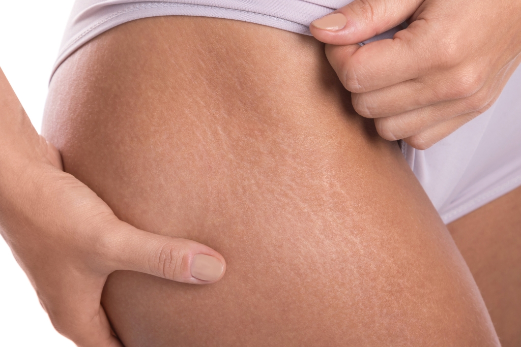 ¿Cómo quitar las estrías? Qué son y cómo prevenirlas